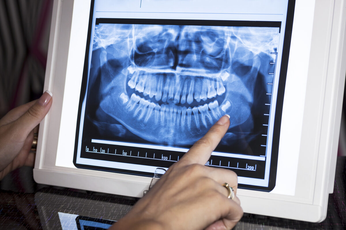 Dentes do siso: 6 dúvidas esclarecidas para manter o sorriso