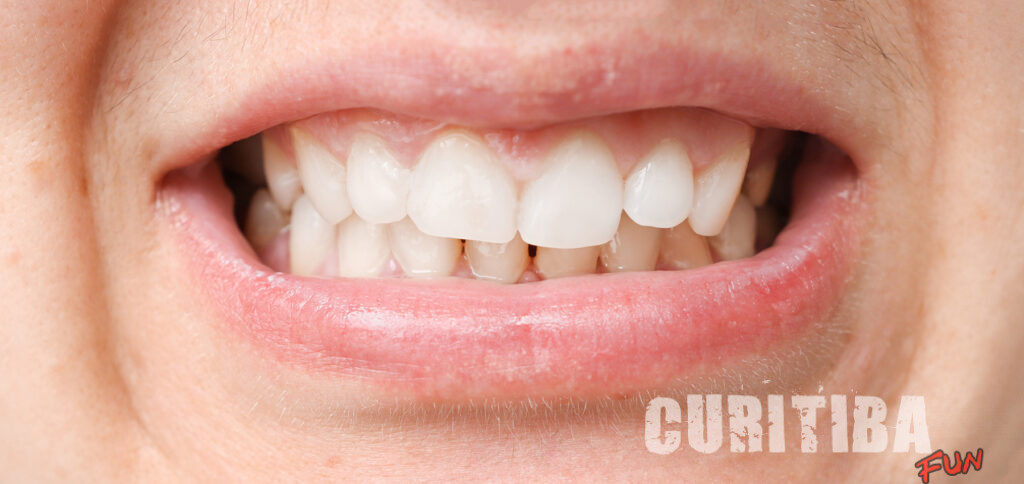 Mordida cruzada: como ela afeta as atividades do dia a dia? Mordida cruzada: como ela afeta as atividades do dia a dia?