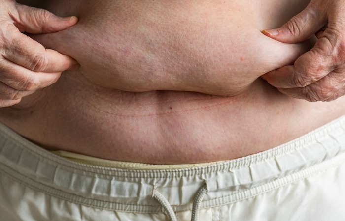 Bariátrica pode reduzir risco de câncer de mama em mulheres obesas Bariátrica pode reduzir risco de câncer de mama em mulheres obesas