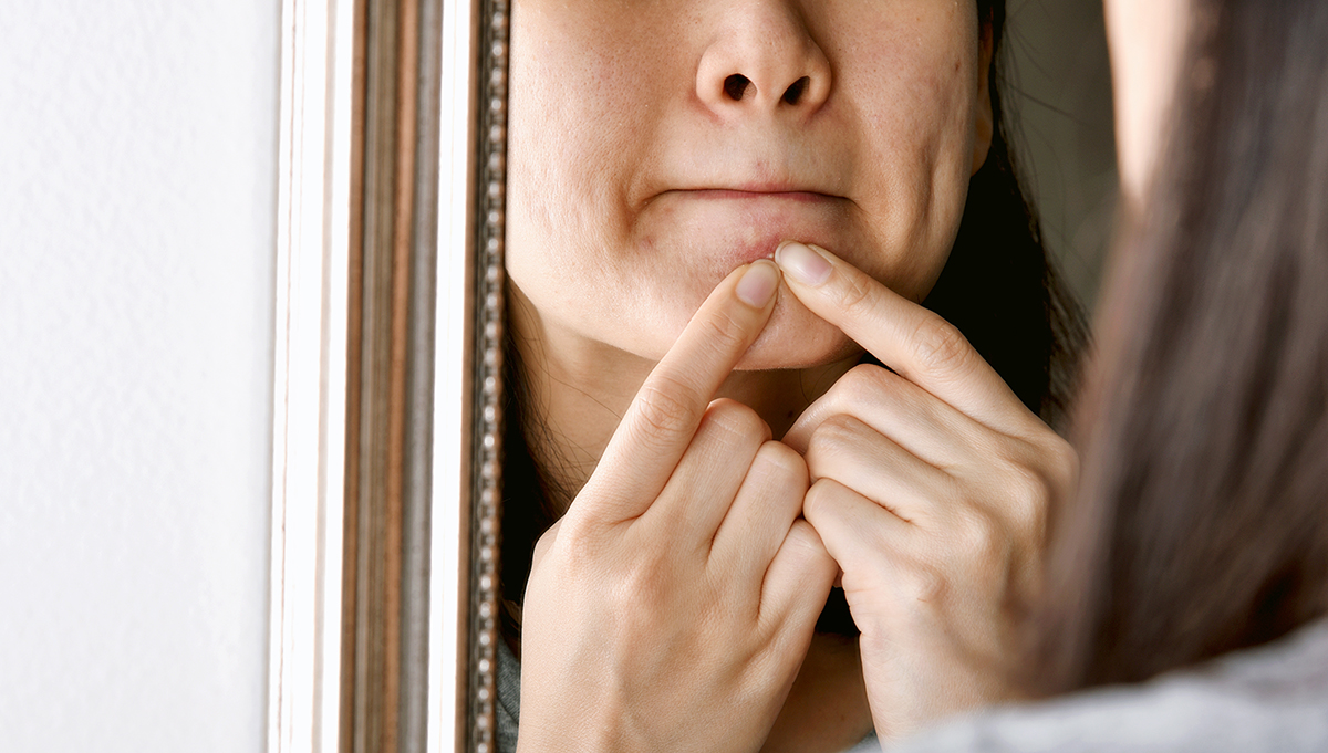 Riscos da acne: bactéria presente na pele pode causar complicações graves ao entrar na corrente sanguínea