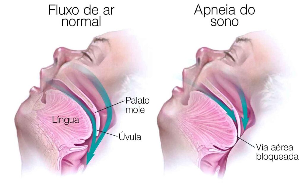 Apneia do sono: uma ameaça silenciosa à saúde