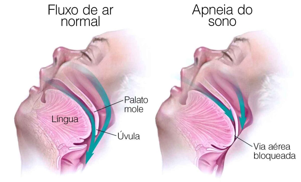 Apneia do sono: uma ameaça silenciosa à saúde