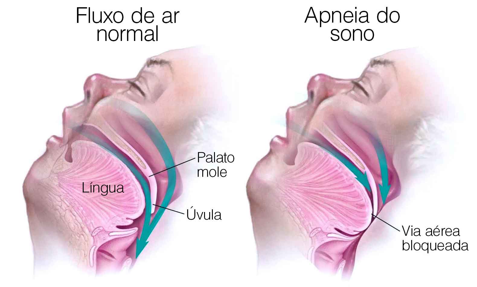 Apneia do sono: uma ameaça silenciosa à saúde