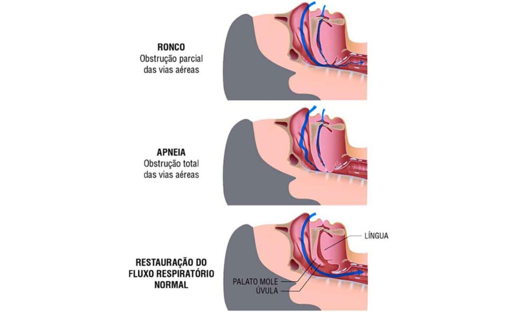 Respirar pela boca pode estar prejudicando sua saúde Respirar pela boca pode estar prejudicando sua saúde
