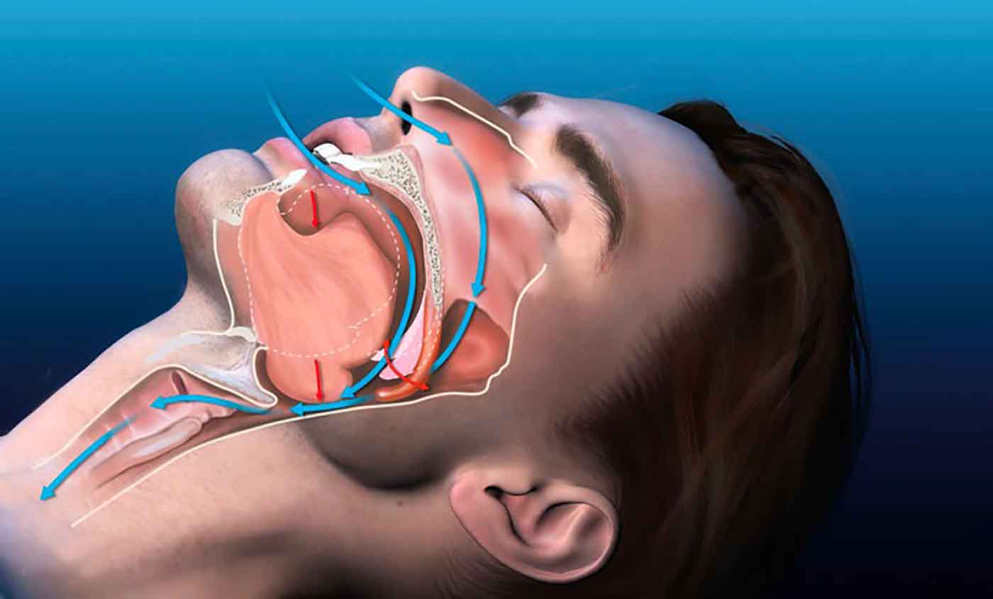 Ronco e apneia: desvendando os mitos sobre tratamentos naturais