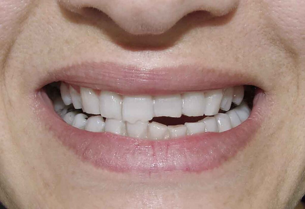 Perigos do bruxismo à saúde e ao bem-estar Perigos do bruxismo à saúde e ao bem-estar