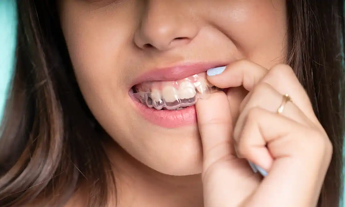 Alinhadores transparentes podem ser usados na prevenção de tratamentos mais complexos em crianças e adolescentes