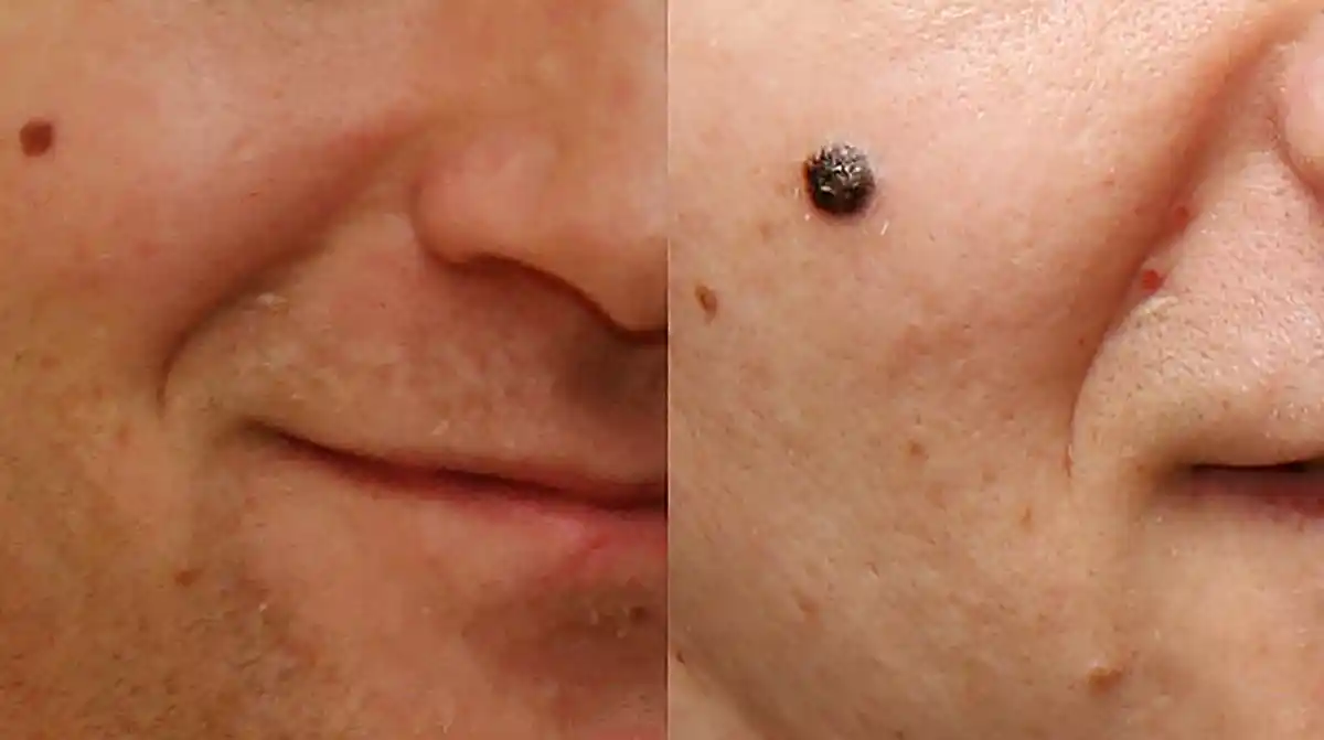 Junho Preto: mês de combate ao melanoma, a forma mais letal do câncer de pele