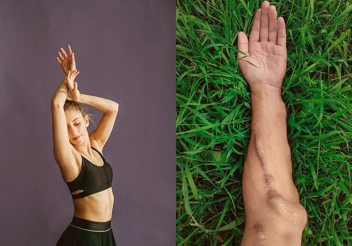 Silicone: um aliado na cicatrização