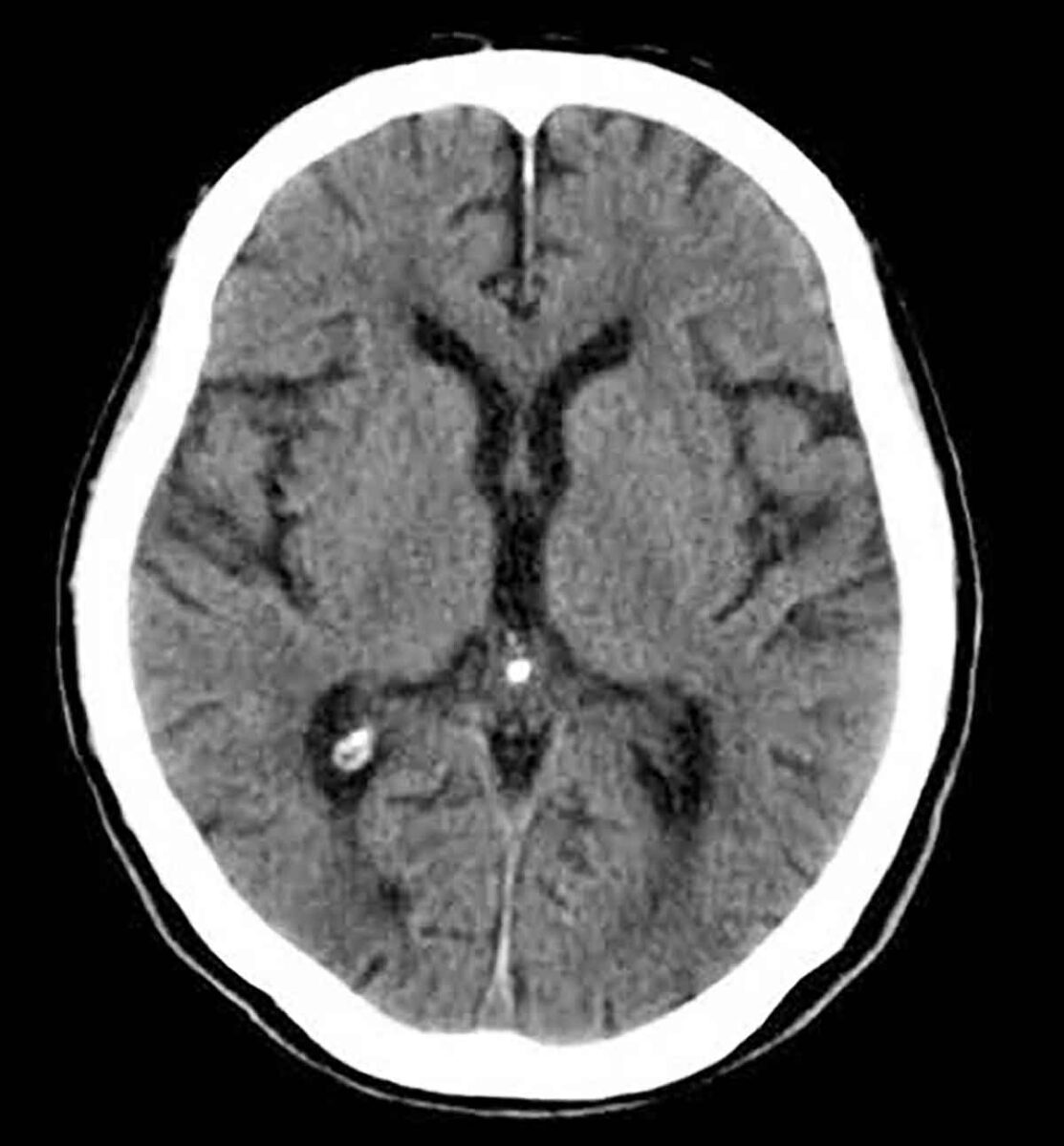 Morte encefálica não é coma: entenda o diagnóstico e por que ele é essencial para a doação de órgãos Morte encefálica não é coma: entenda o diagnóstico e por que ele é essencial para a doação de órgãos