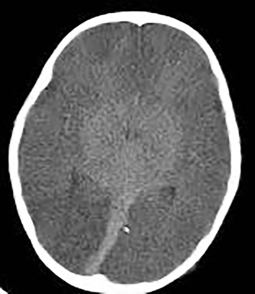 Morte encefálica não é coma: entenda o diagnóstico e por que ele é essencial para a doação de órgãos Morte encefálica não é coma: entenda o diagnóstico e por que ele é essencial para a doação de órgãos