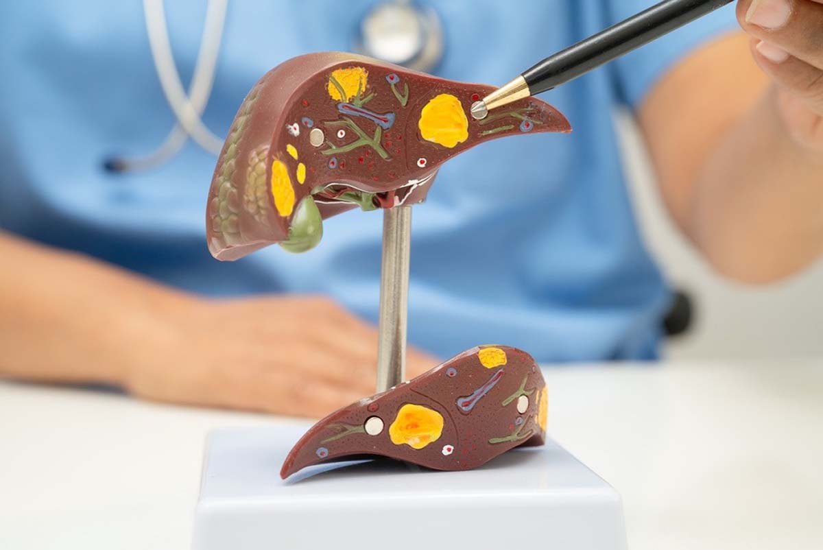 Gordura no fígado: Brasil é um dos países com maior incidência de esteatose hepática do mundo