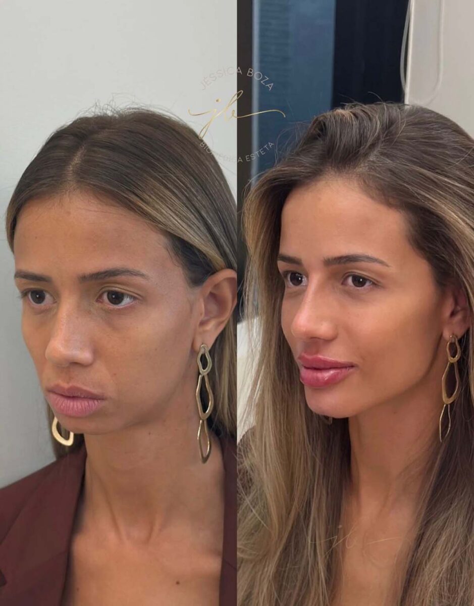Harmonização facial prioriza naturalidade e equilíbrio em vez de excesso de volume Harmonização facial prioriza naturalidade e equilíbrio em vez de excesso de volume