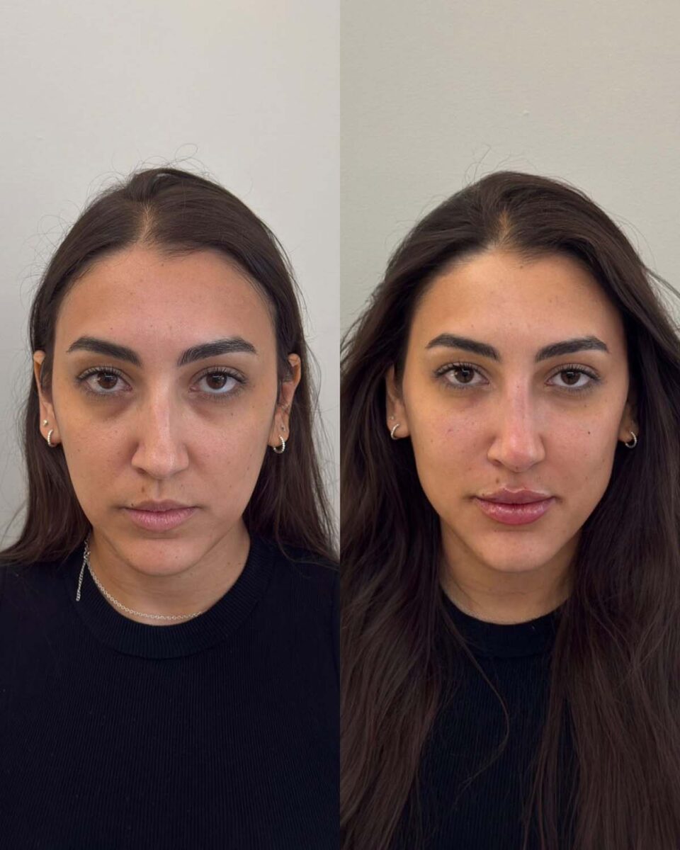 Harmonização facial prioriza naturalidade e equilíbrio em vez de excesso de volume Harmonização facial prioriza naturalidade e equilíbrio em vez de excesso de volume