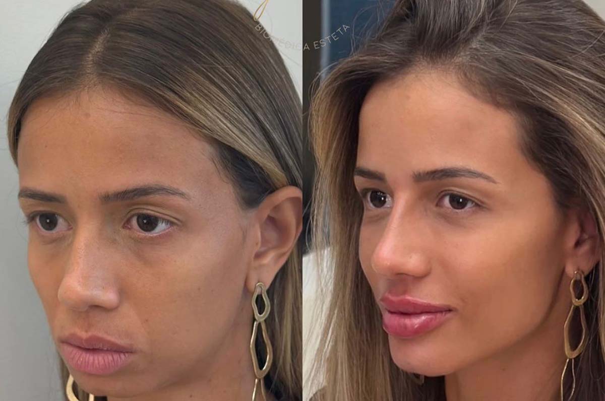 Harmonização facial prioriza naturalidade e equilíbrio em vez de excesso de volume