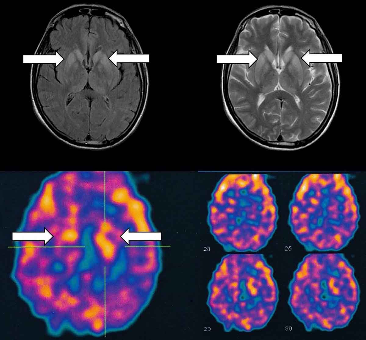 Doenças neurodegenarativas: o caso de Lito Sousa e a importância de estudos clínicos internacionais Doenças neurodegenarativas: o caso de Lito Sousa e a importância de estudos clínicos internacionais