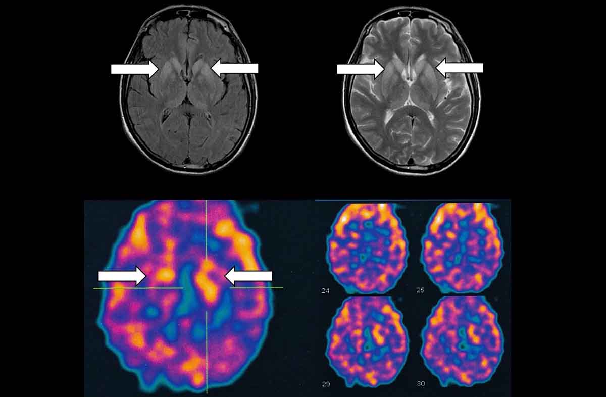 Doenças neurodegenarativas: o caso de Lito Sousa e a importância de estudos clínicos internacionais